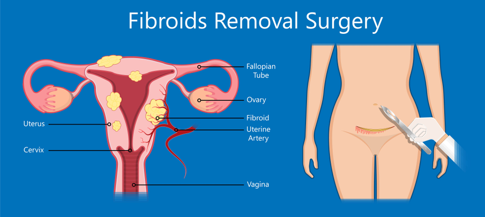 Fibroids Removal Surgery