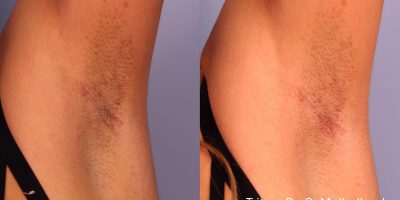 Armpits Laser Hair Removal Services by Poplar Med Spa