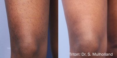 Thighs Laser Hair Removal Services by Poplar Med Spa