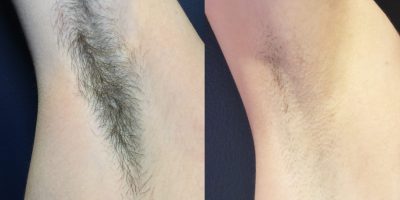 Armpits Laser Hair Removal Services by Poplar Med Spa